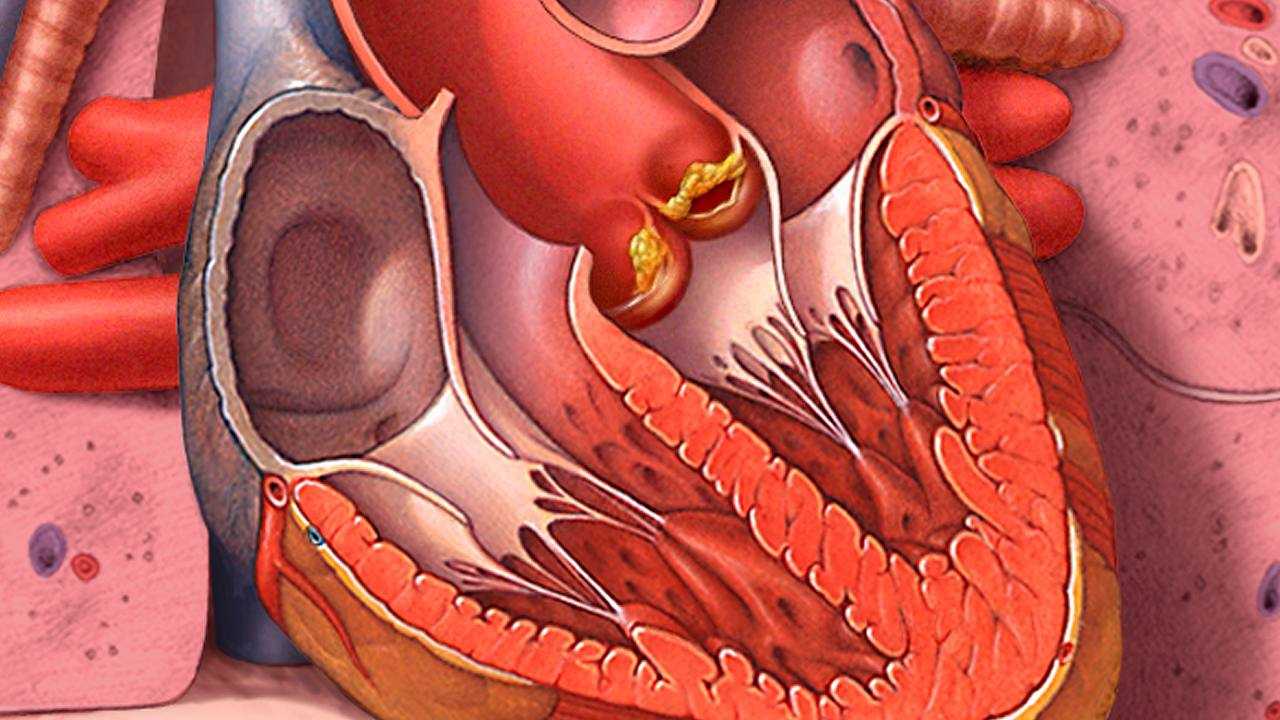 Jarang Sikat Gigi Sebabkan Penyakit Jantung Endokarditis