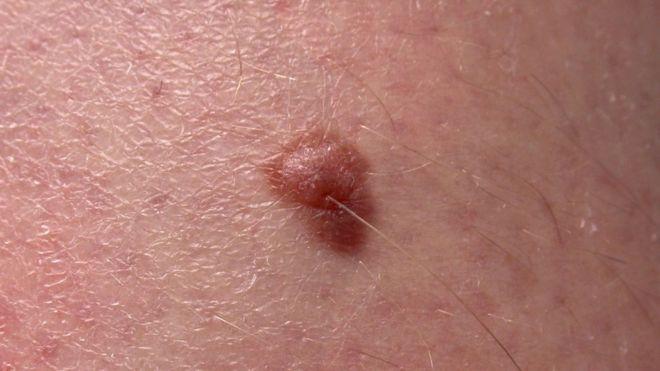 Ilmuwan Australia Temukan Pendeteksi Melanoma