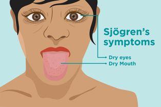 Kenali Gejala Penyakit Autoimun Sindrom Sjogren